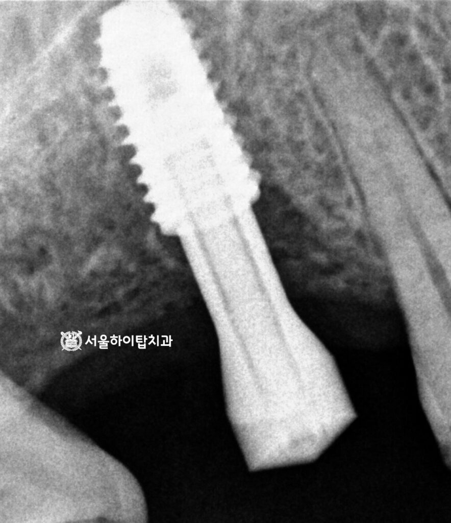 최종 보철 제작을 위해 스캔바디 체결 후
스캔 진행