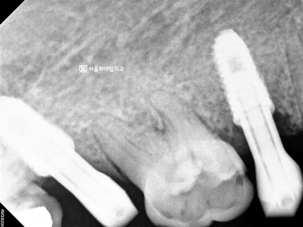 최종 보철 제작을 위해 스캔바디 체결 후
스캔 진행