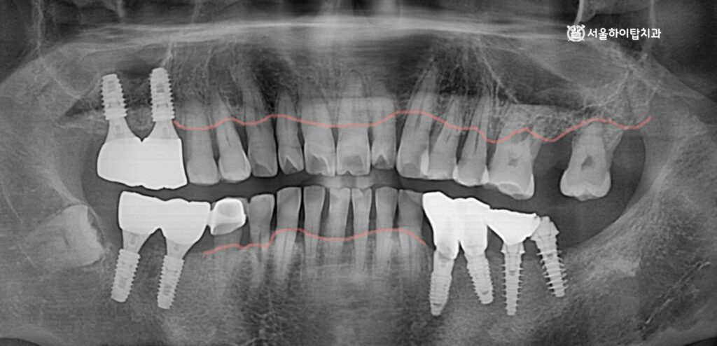 간석역 치과,
파노라마 엑스레이에서 유독 어금니에만 임플란트가 심어진 모습.
그리고 전체적으로 진행 중인 치조골 흡수 양상
