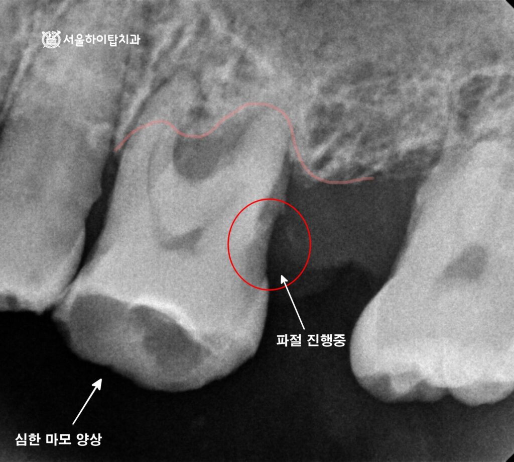 간석역 치과
위턱(상악) 큰 어금니에서
심한 골 흡수로 잇몸 조직이 치아를 겨우 붙잡고 있으며 교합면 마모와 근심면 파절이 진행 중인 모습