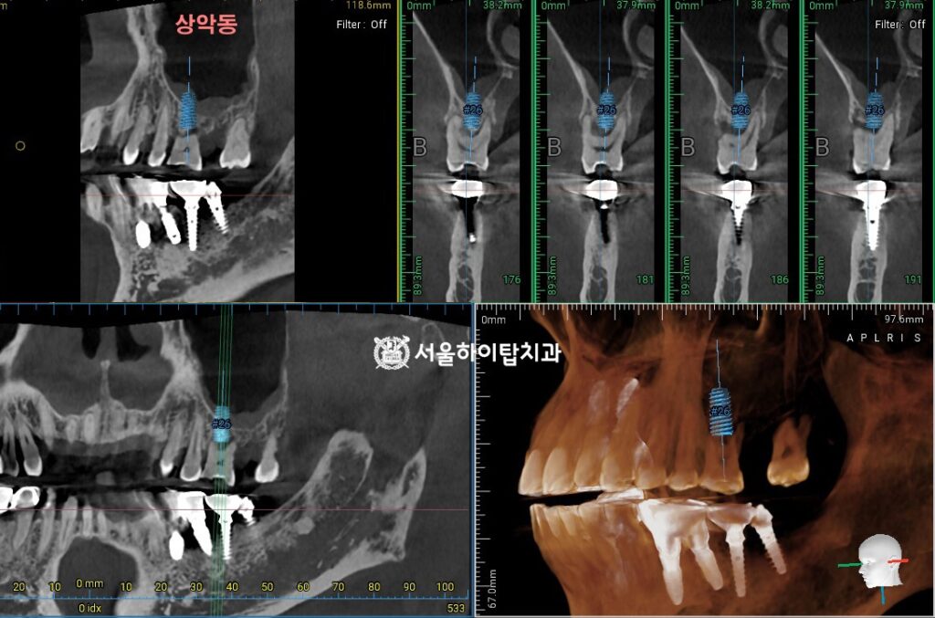 CT 기반 임플란트 식립 가상 시뮬레이션 