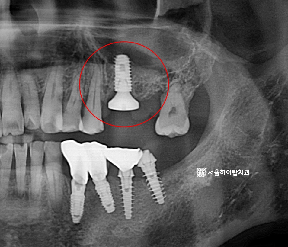 가상시뮬레이션 데이터를 기반으로 한
임플란트 뿌리(픽스처)가 안전하게 심어진 모습