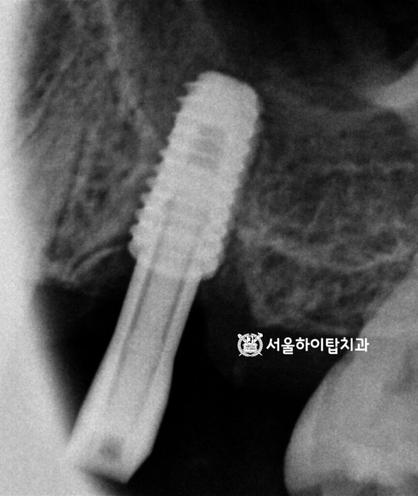 최종 보철물 제작을 위한 스캔바디 체결