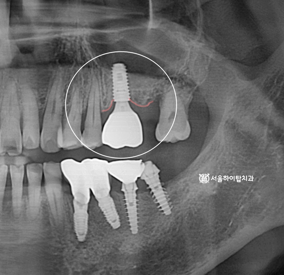 지르코니아 크라운이 장착된
최종 모습