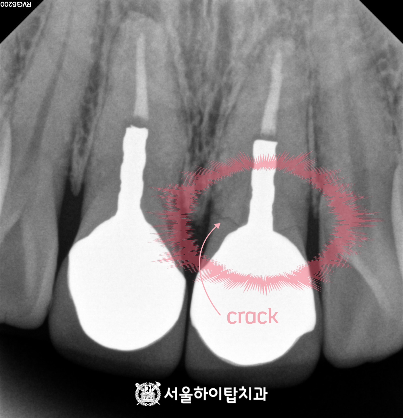 간석오거리역치과 앞니 크라운 파절 치근단 크랙 사진