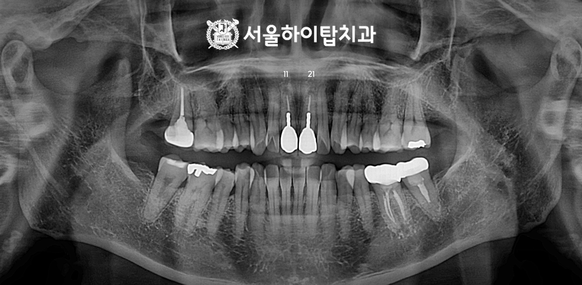 간석오거리역치과 앞니 파절 진단 파노라마 사진