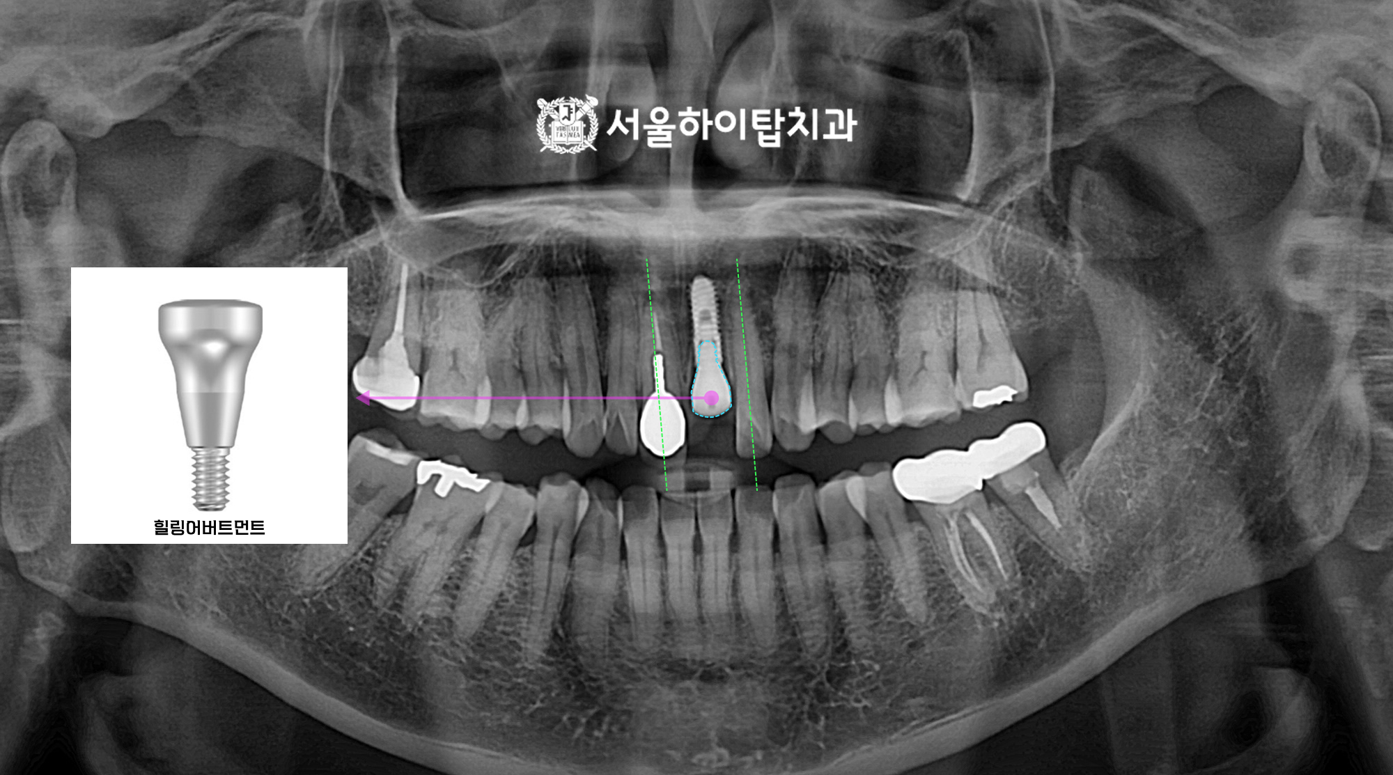 간석오거리역치과 임플란트 식립 후 힐링어버트먼트 파노라마 사진