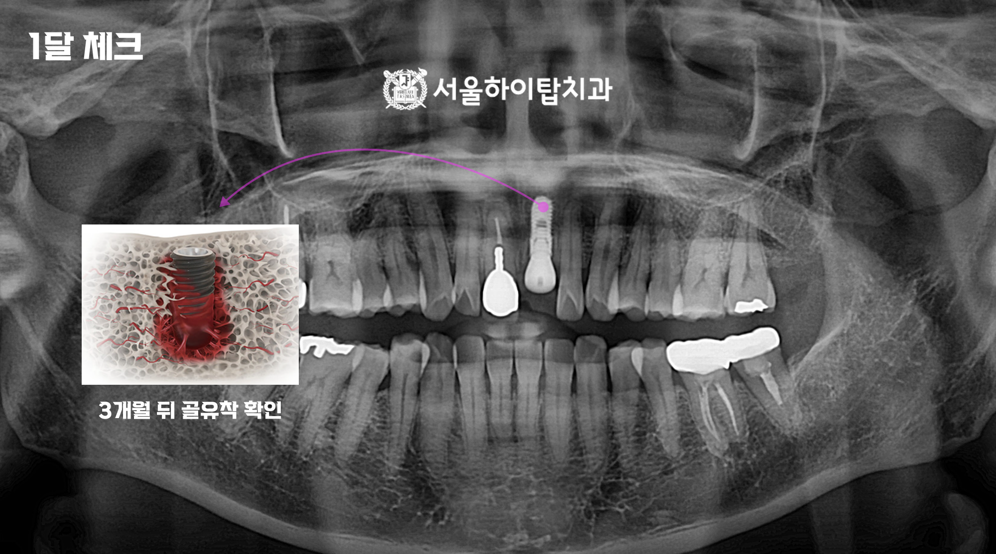 간석오거리역치과 임플란트 식립 1개월 경과 관찰 파노라마 사진