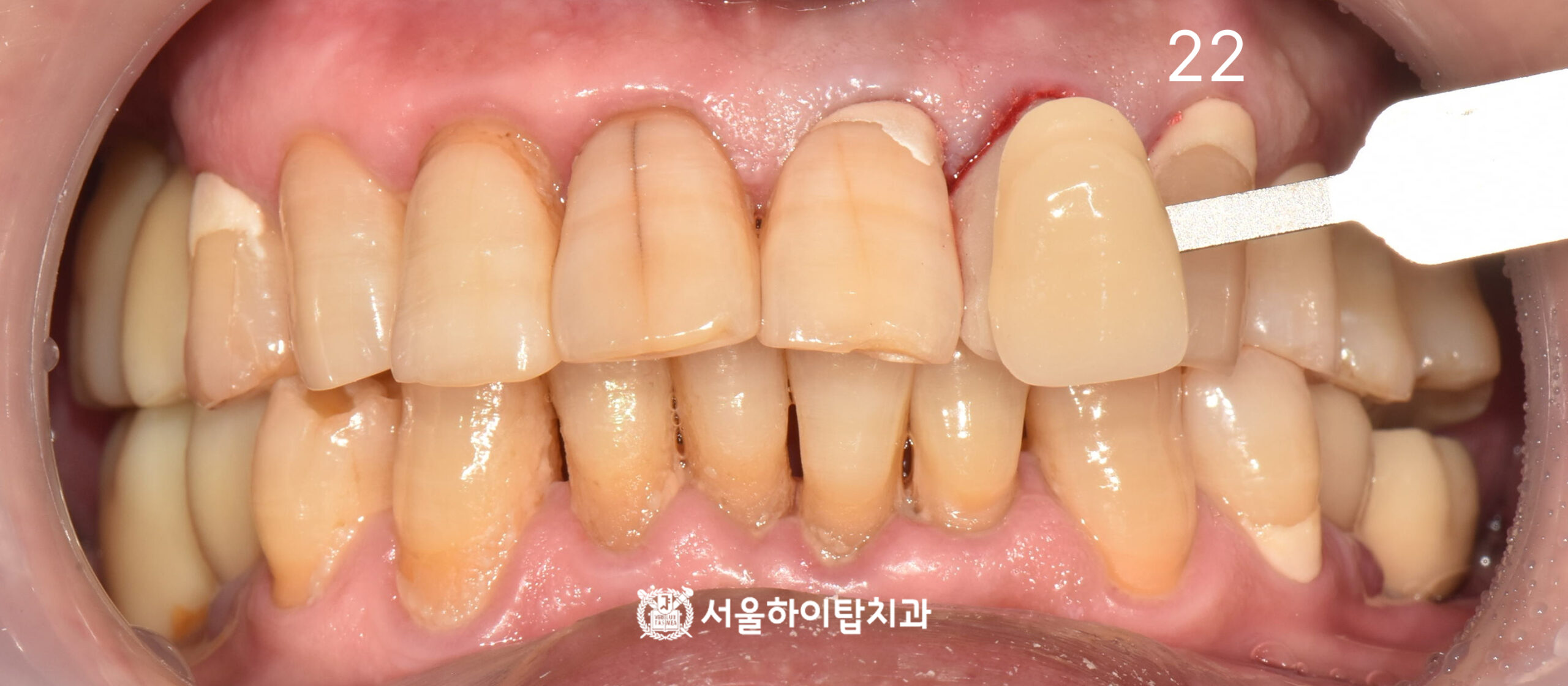 동암역치과 #22 신경치료 완료 후 크라운 보철 의뢰 전 쉐이드 테이킹 사진
