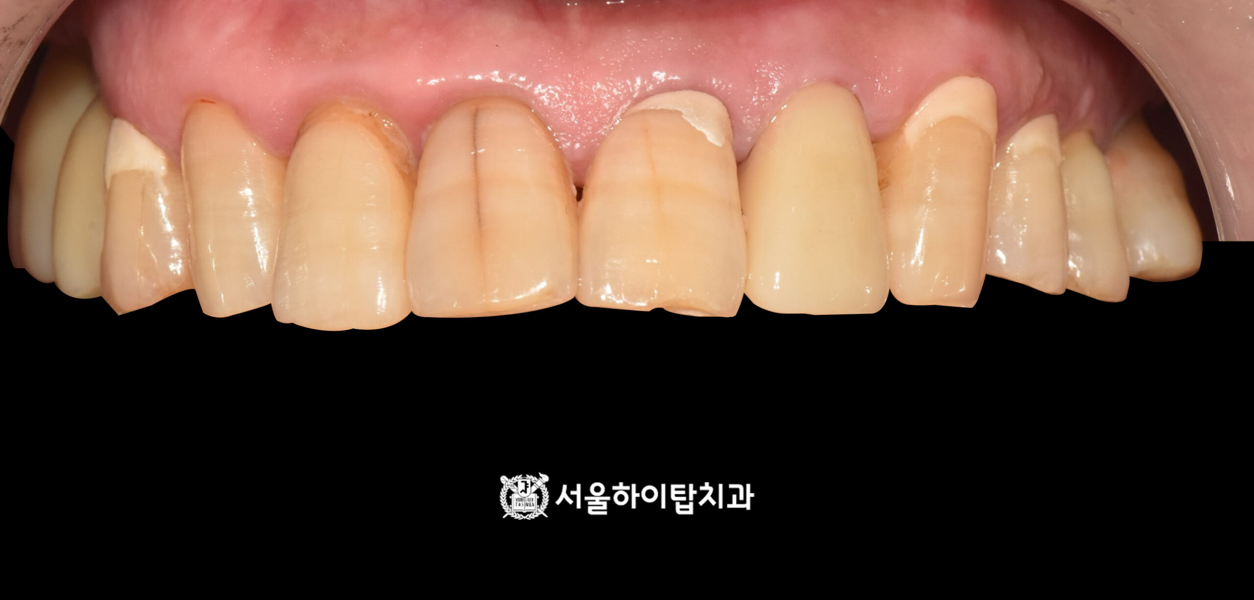 동암역치과 #22 신경치료 완료 크라운 장착 전 구내 전면 사진