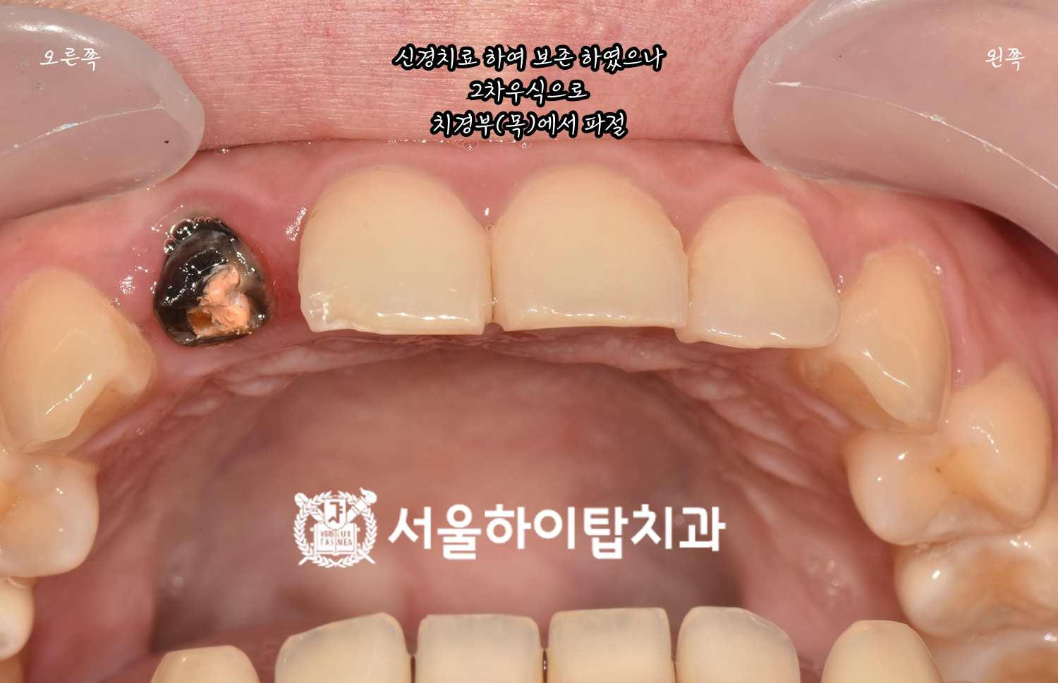 동암역치과 진단 구강 사진 — 2차 우식으로 검게 변한 치질