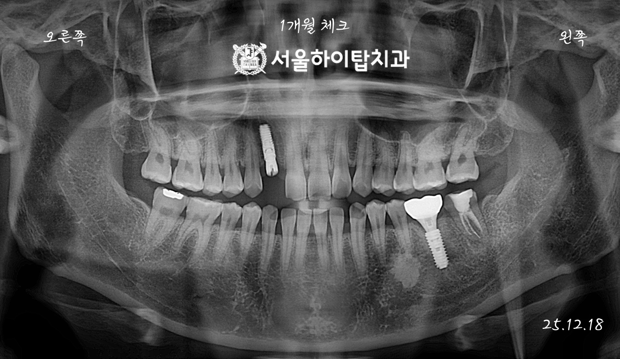 동암역치과 식립 1개월 파노라마 — 임플란트 경과 확인