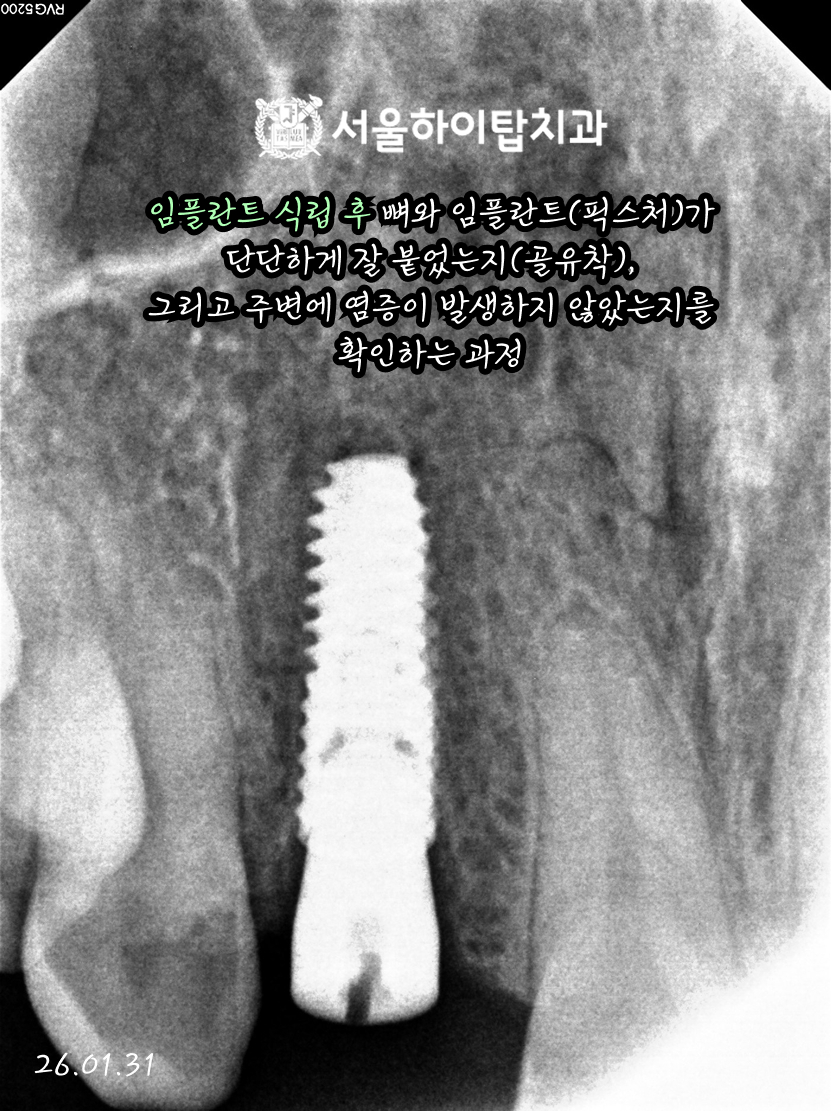 동암역치과 식립 2개월 치근단 방사선 사진 — 임플란트 주위 뼈 상태 확인