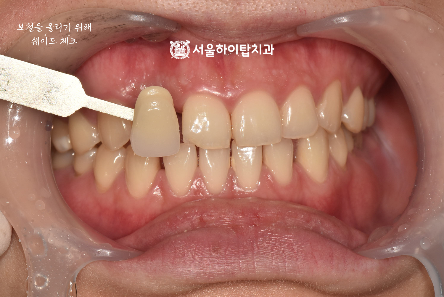 동암역치과 보철 색상(shade) 체크 — 앞니 임플란트 상부 보철 제작 전
