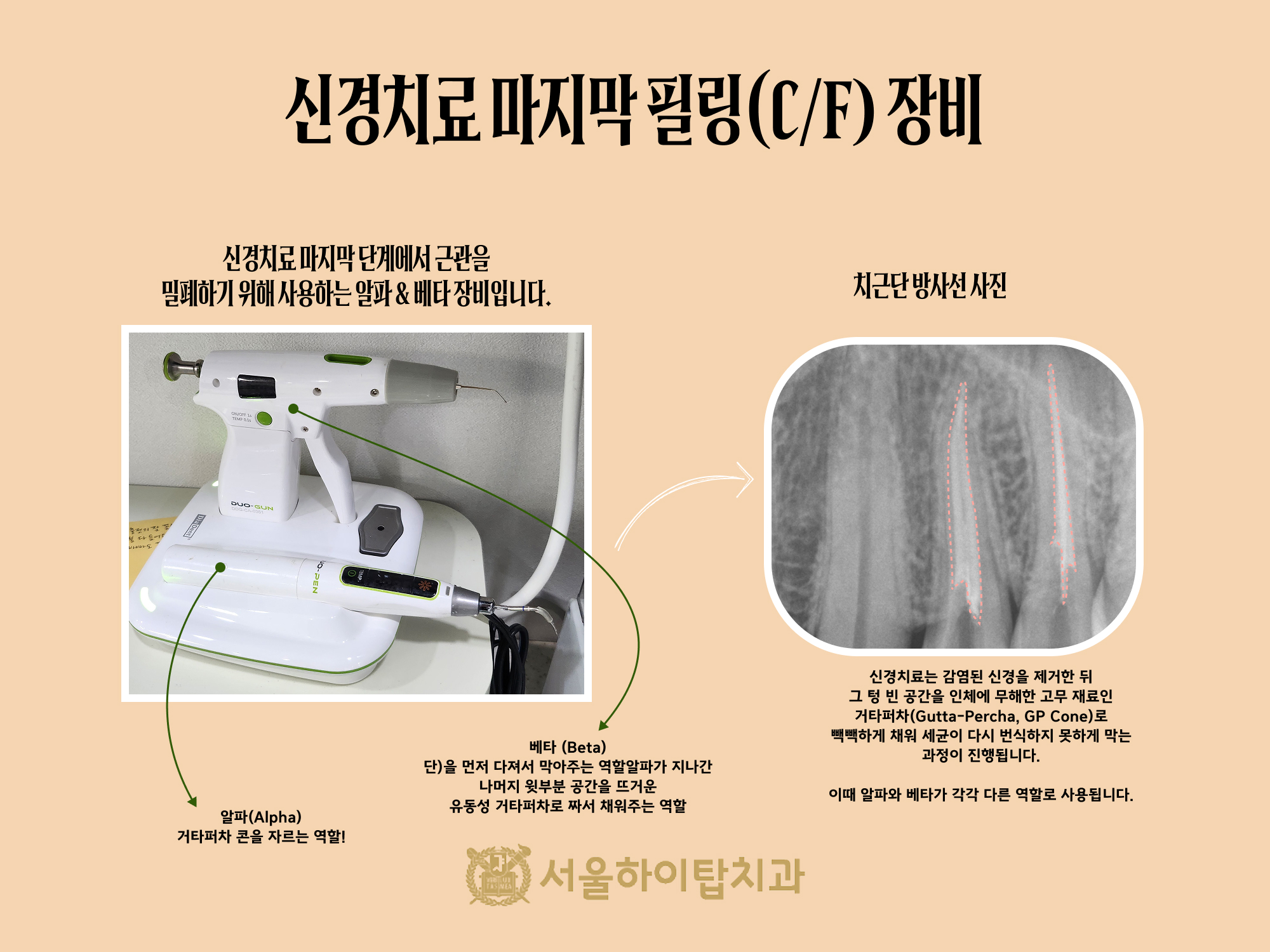간석오거리역치과 근관충전(C/F) 완료 후 치근단방사선 사진 — 근관 내부 충전 상태 확인