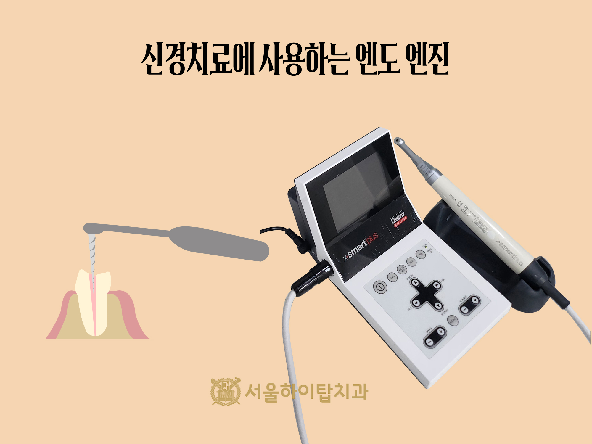 간석오거리역치과 신경치료에 사용하는 엔도 엔진 — 근관 성형용 파일을 회전시키는 장비